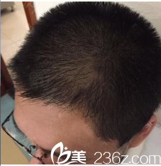 廣州植發(fā)哪家好？看我花1萬多元找廣州壹加壹游鳳軍做的發(fā)際線種植效果怎么樣