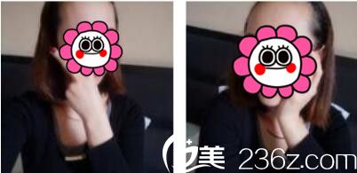 韓國毛尚毛發(fā)移植醫(yī)院樸正一發(fā)際線種植真人案例術(shù)前照 韓國毛尚毛發(fā)移植醫(yī)院樸正一發(fā)際線種植真人案例術(shù)前照