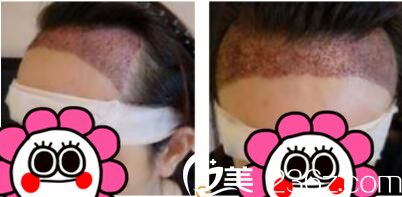 韓國毛尚毛發(fā)移植醫(yī)院樸正一發(fā)際線種植真人案例術(shù)后第三天 韓國毛尚毛發(fā)移植醫(yī)院樸正一發(fā)際線種植真人案例術(shù)后第三天