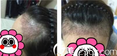 韓國毛尚毛發(fā)移植醫(yī)院樸正一發(fā)際線種植真人案例術(shù)后十一天 韓國毛尚毛發(fā)移植醫(yī)院樸正一發(fā)際線種植真人案例術(shù)后十一天