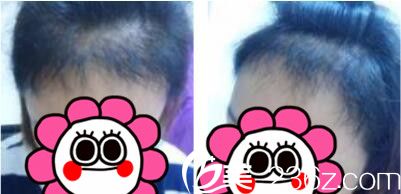 韓國毛尚毛發(fā)移植醫(yī)院樸正一發(fā)際線種植真人案例術(shù)后三個(gè)月 韓國毛尚毛發(fā)移植醫(yī)院樸正一發(fā)際線種植真人案例術(shù)后三個(gè)月