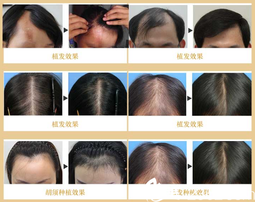 廣州華美整形醫(yī)院代慶成醫(yī)生植發(fā)案例圖片 廣州華美整形醫(yī)院代慶成醫(yī)生植發(fā)案例圖片