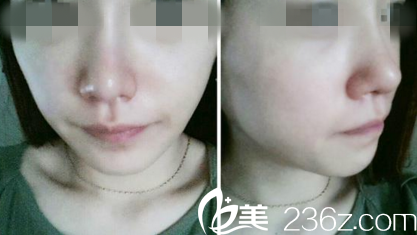 手術(shù)半個(gè)月后 手術(shù)半個(gè)月后