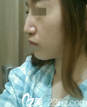 手術(shù)前鷹鉤鼻的我 手術(shù)前鷹鉤鼻的我