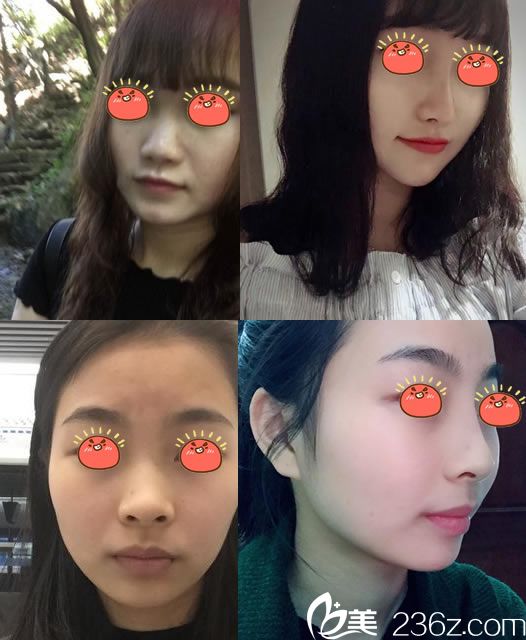 寧波時光美極孫震隆鼻案例 寧波時光美極孫震隆鼻案例