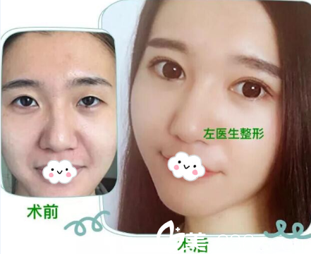 玉溪左醫(yī)生七夕整形價格表公布啦,順便看雙眼皮隆鼻效果怎么樣?