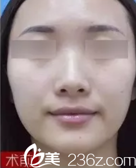 我在運(yùn)城麗都整形美容醫(yī)院做隆鼻前的照片 我在運(yùn)城麗都整形美容醫(yī)院做隆鼻前的照片