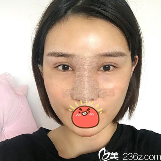 在寧波時光美極剛做完隆鼻和脂肪填充照片