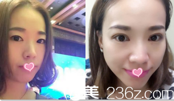 北京華韓雙眼皮 北京華韓雙眼皮