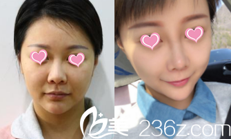 北京華韓假體隆鼻 北京華韓假體隆鼻