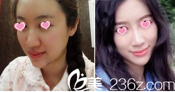 北京華韓面部吸脂 北京華韓面部吸脂