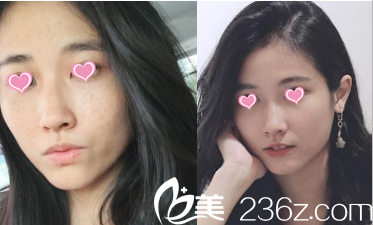 北京華韓去痘印 北京華韓去痘印