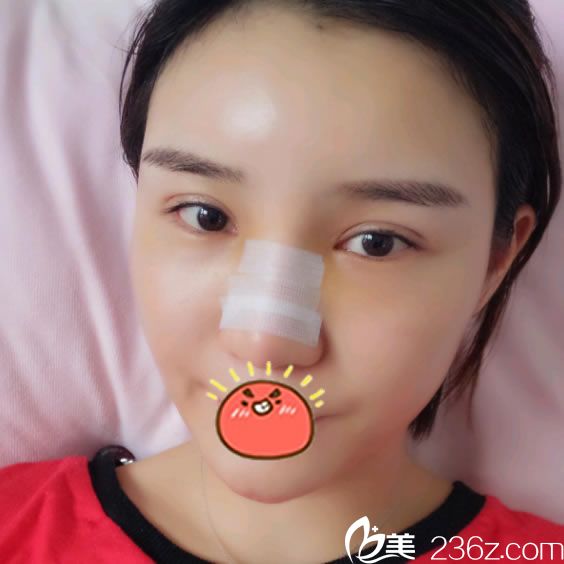 做完膨體耳軟骨鼻綜合和脂肪填充10天后