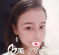 恢復(fù)7天的鼻綜合鼻子高挺