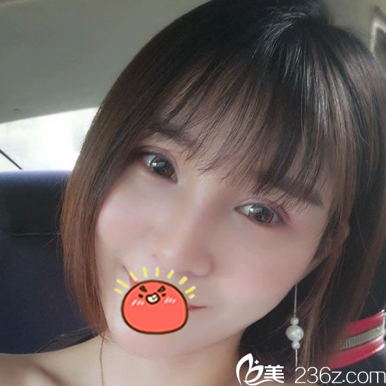 我是寧波時(shí)光美極張醫(yī)生的忠粉了，割雙眼皮后又回來找他做鼻綜合隆鼻和脂肪填充了