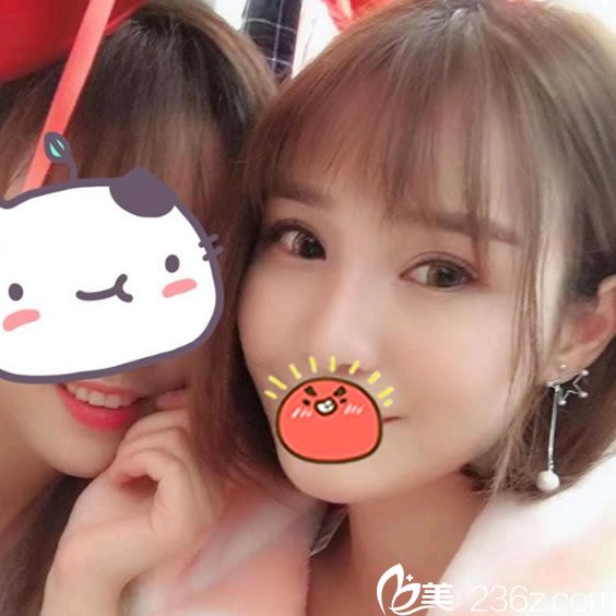 做完自體脂肪填充和隆鼻3個月照片