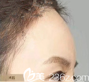 天生額頭扁平？來看看長(zhǎng)春東方自體脂肪填充額頭案例你就知道怎么做