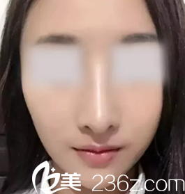 看了閨蜜在運(yùn)城麗都整形做的激光祛斑效果，我去找楊順新院長(zhǎng)做了鼻綜合