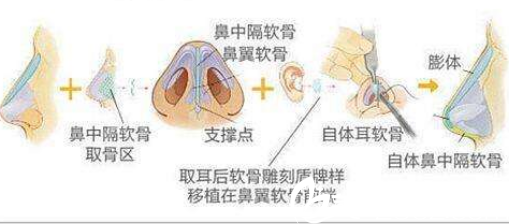 長春東方鼻綜合手術(shù)過程