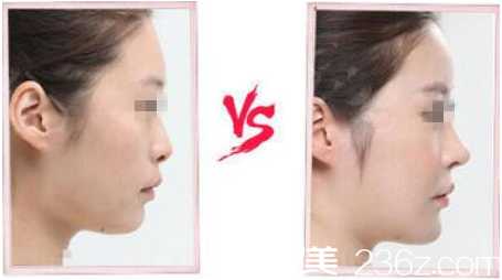 長春東方鼻綜合手術(shù)案例