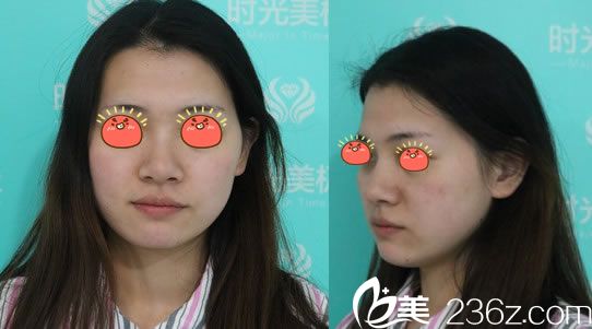 在寧波時光美極做脂肪填充前 在寧波時光美極做脂肪填充前