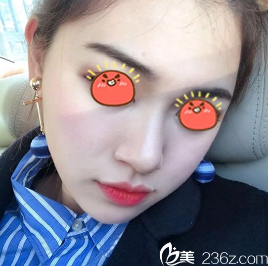 在時光美極做脂肪填充20天后 在時光美極做脂肪填充20天后