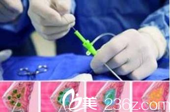 三亞維多利亞獨特的奧美定取出優(yōu)勢