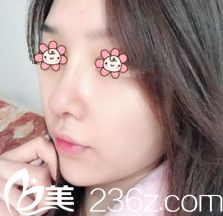 金順珍鼻綜合術(shù)后半個(gè)月