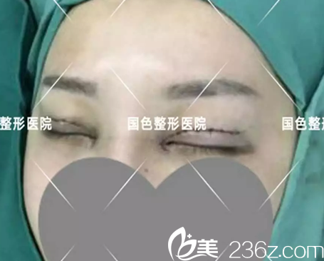 全切雙眼皮+開內(nèi)眼角術(shù)后即刻