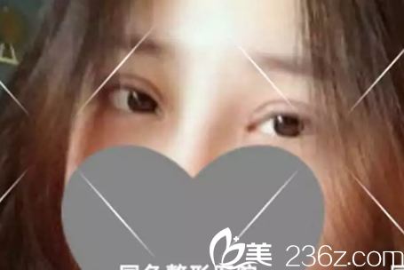 蚌埠國色整形全切雙眼皮加開內(nèi)眼角術(shù)后第7天圖