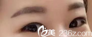 YNT整形醫(yī)院雙眼皮手術前