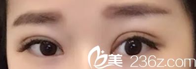 李秉烈醫(yī)生全切雙眼皮40天恢復圖