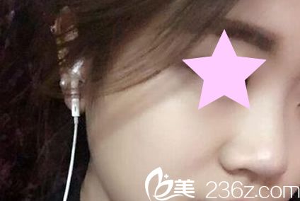 韓國YNT整形醫(yī)院硅膠隆鼻手術(shù)前 韓國YNT整形醫(yī)院硅膠隆鼻手術(shù)前