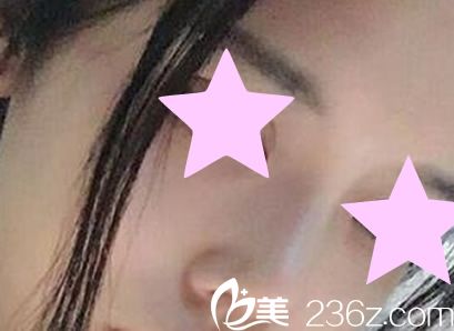 硅膠隆鼻7天后恢復(fù)效果圖 硅膠隆鼻7天后恢復(fù)效果圖