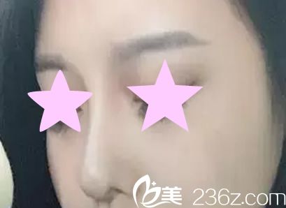 韓國YNT整形醫(yī)院尹炯老醫(yī)生給我做了硅膠假體隆鼻后 鼻子更立體了