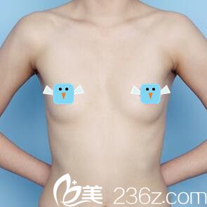 假體隆胸術(shù)前照 假體隆胸術(shù)前照