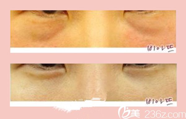 徐元德醫(yī)生激光去黑眼圈案例 徐元德醫(yī)生激光去黑眼圈案例