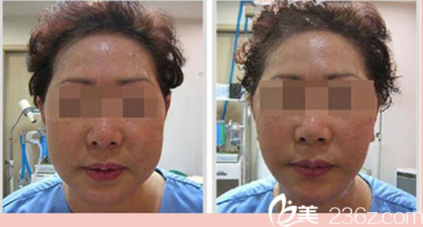 卞賢燮醫(yī)生面部提升手術(shù)真人案例分享