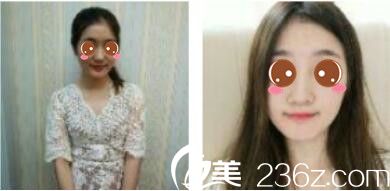 韓國休&美整形外科徐義錫假體隆鼻真人案例術(shù)前照 韓國休&美整形外科徐義錫假體隆鼻真人案例術(shù)前照