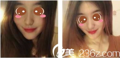 韓國休&美整形外科徐義錫假體隆鼻真人案例術(shù)后一個(gè)月 韓國休&美整形外科徐義錫假體隆鼻真人案例術(shù)后一個(gè)月