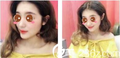 五一的時候去韓國休&美做了假體隆鼻，徐義錫隆鼻技術(shù)沒的說特別高挺自然