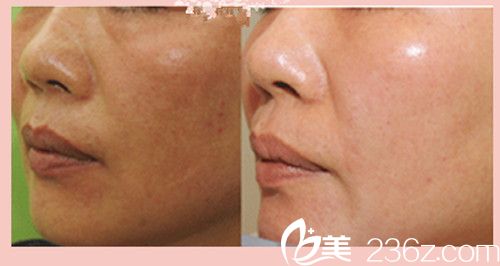 金敏英激光去除黃褐斑案例分享