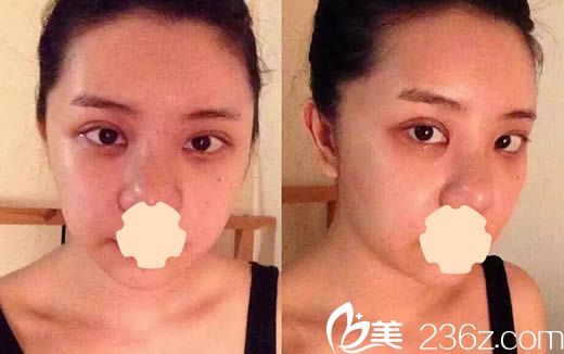 韓國安娜柯琳整形雙眼皮術(shù)后兩個月 韓國安娜柯琳整形雙眼皮術(shù)后兩個月