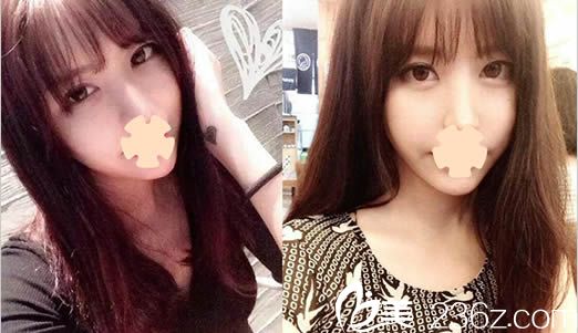 我去韓國(guó)安娜柯琳整形外科做了雙眼皮修復(fù)和面部輪廓整形后，變成了網(wǎng)紅小V臉