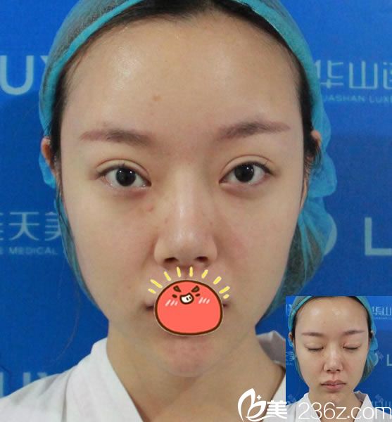 在杭州連天美做雙眼皮修復(fù)前 在杭州連天美做雙眼皮修復(fù)前