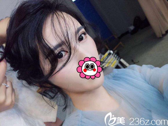 很開心武漢涵美設(shè)計(jì)的切開雙眼皮讓我變電眼美女