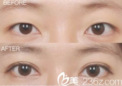 東莞水立方美容醫(yī)院雙眼皮案例圖