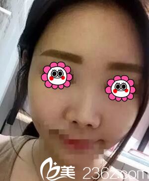 去懷化韓美做鼻綜合術(shù)前照 去懷化韓美做鼻綜合術(shù)前照