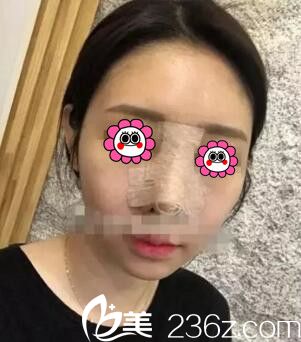 懷化韓美鼻綜合術(shù)后第2天 懷化韓美鼻綜合術(shù)后第2天