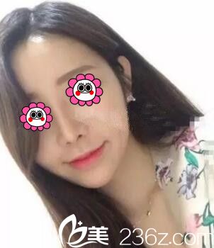 看到閨蜜在懷化韓美整形醫(yī)院做的硅膠假體綜合隆鼻效果不錯(cuò)于是我也來(lái)做個(gè)